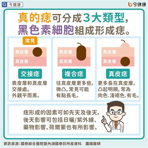 臉頰長痣代表什麼|是痣？皮膚癌？還是什麼？常見Q&A解惑！醫教揪出「。